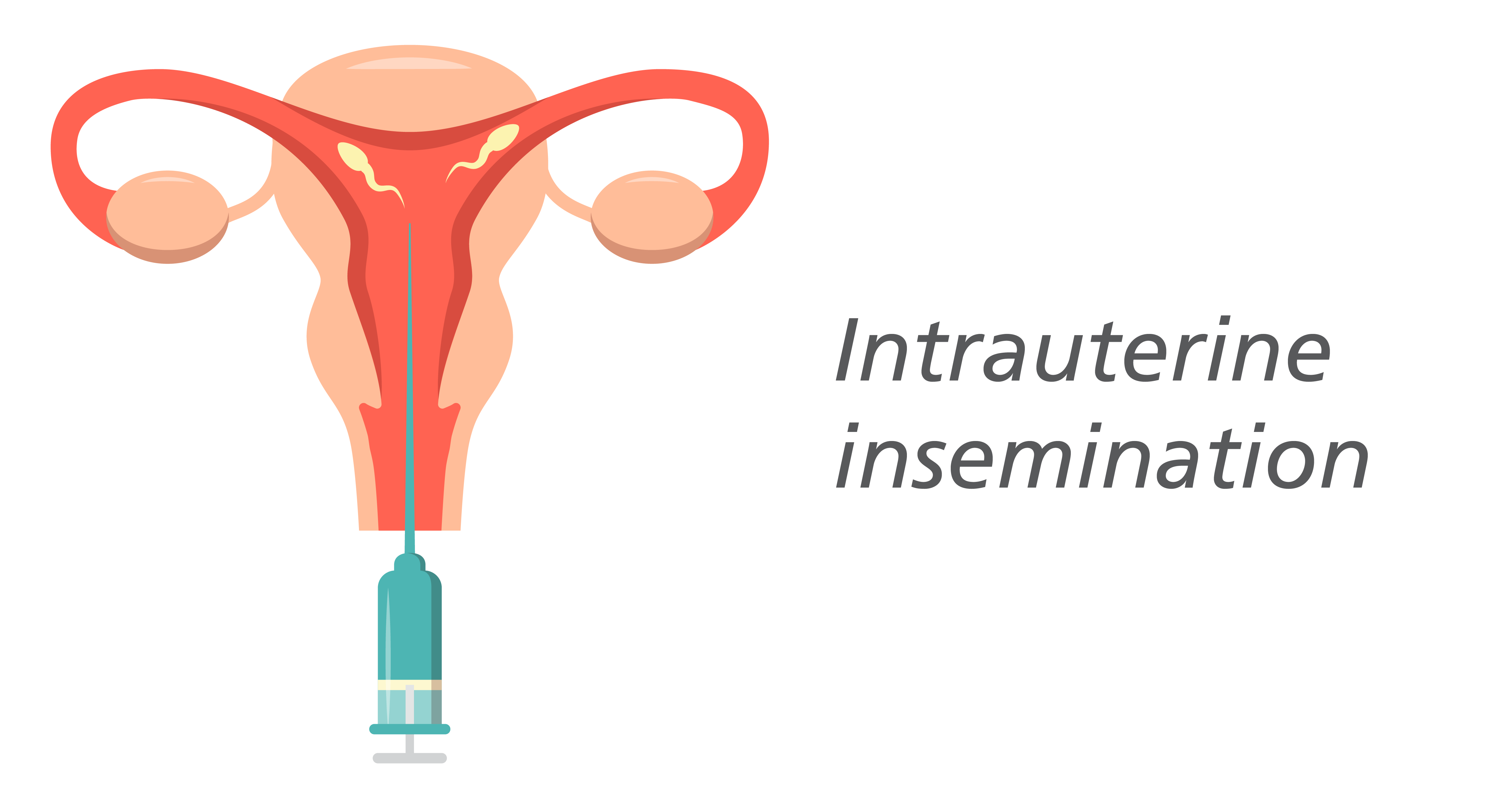 IUI IUI